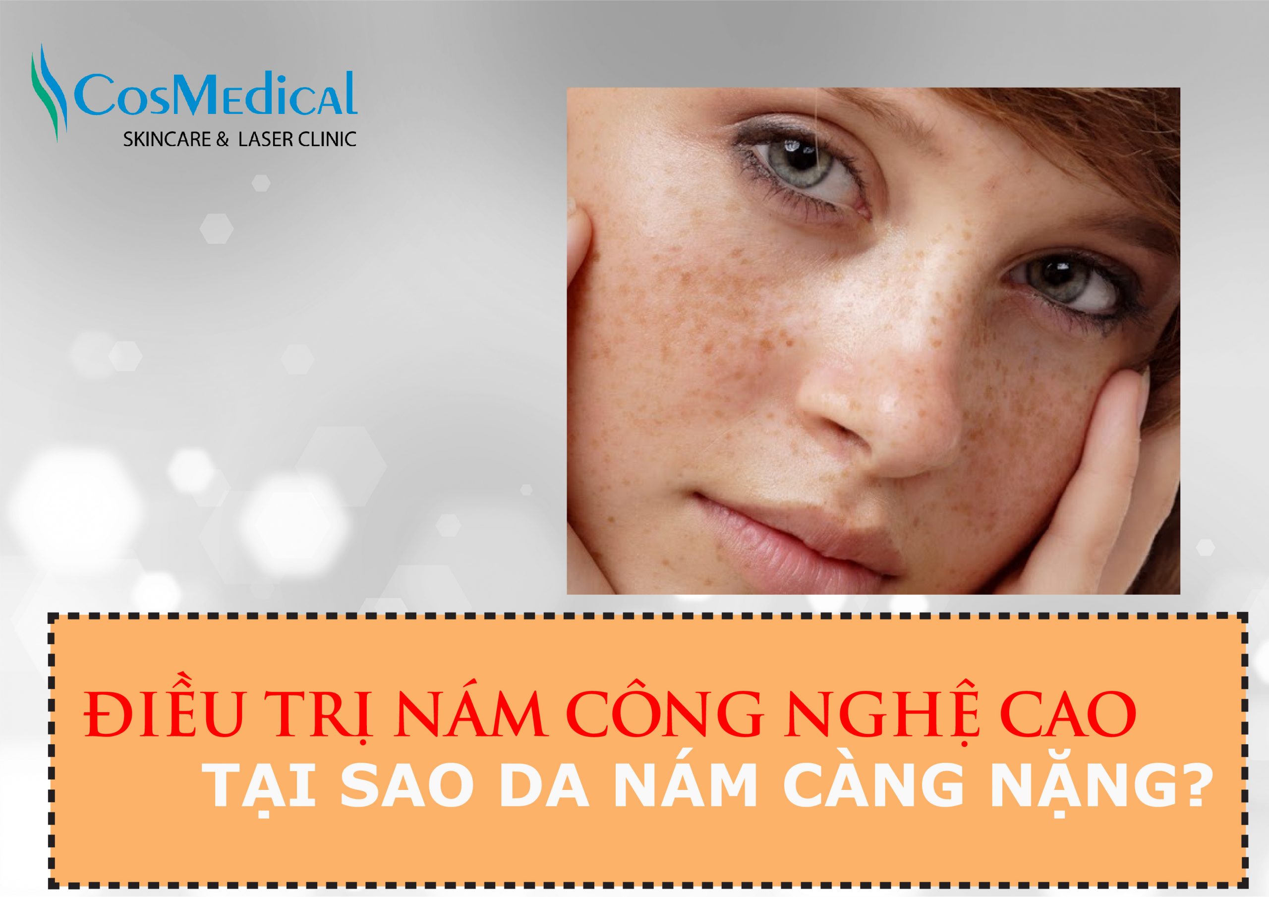 Điều trị nám da mặt công nghệ cao nhưng da nám càng nặng