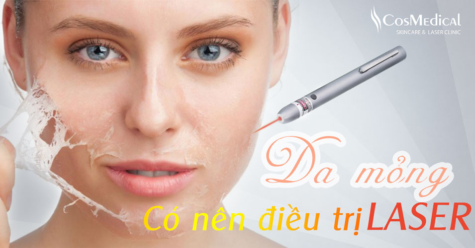 da mỏng có nên điều trị nám bằng laser