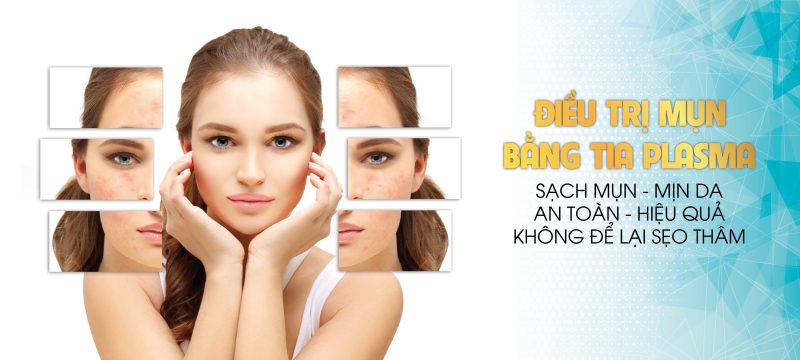 điều trị mụn ẩn bằng plasma